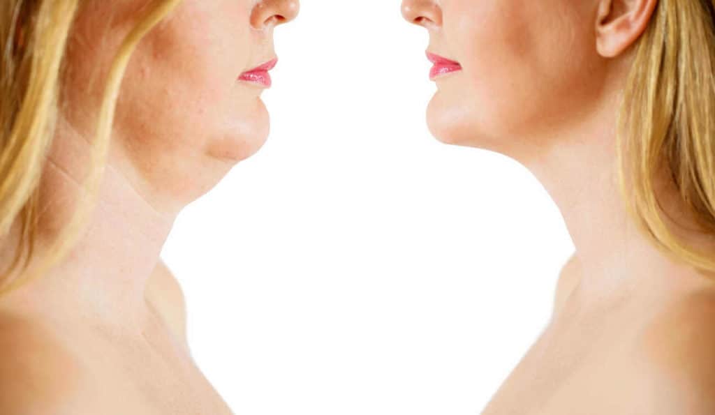 Double Chin treatment Great Yarmouth before and after results
