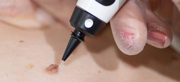 After Skin Tag Removal Great Yarmouth