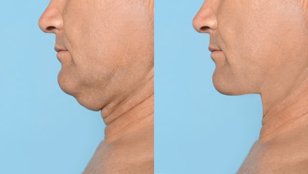 Which Non-Surgical Treatments Work Best for Jowls and Loose Skin Great Yarmouth?