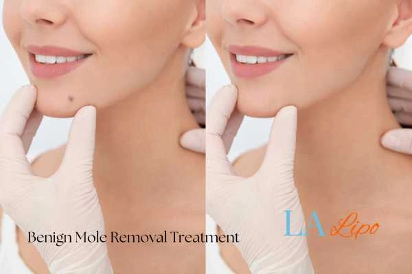 woman's before and after mole removal Great Yarmouth results