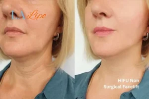 hi-fu for wrinkles Great Yarmouth before and after results
