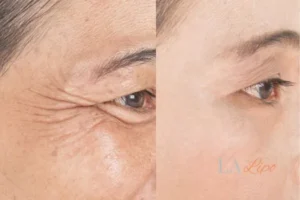 Before and after results of woman - HI-fu wrinkles reduction treatment Great Yarmouth