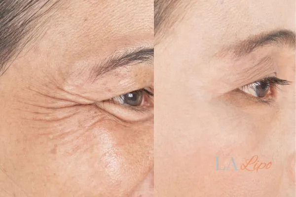 Before and after results of woman - HI-fu wrinkles reduction treatment Great Yarmouth
