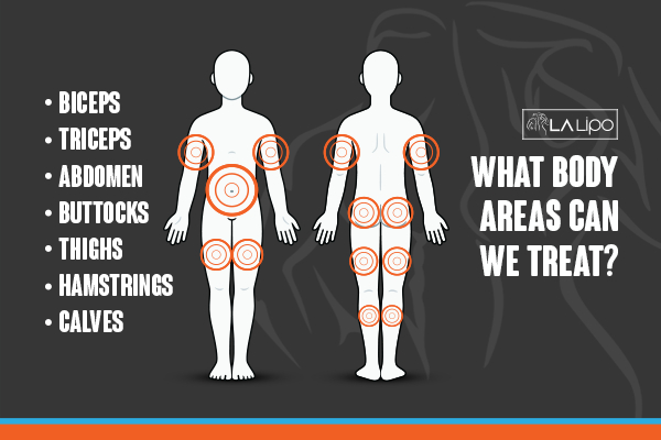 Graphic to show areas you can have LA-EMS Body Sculpting Great Yarmouth treatment.