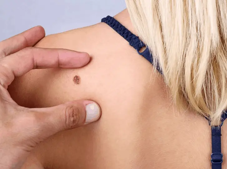 woman having mole removal Great Yarmouth consultation before treatment.