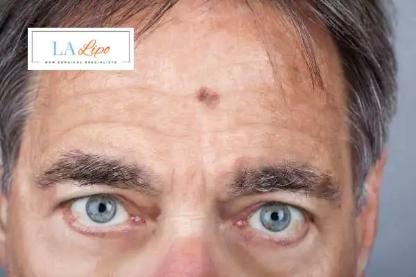 Solar Lentigo Removal Great Yarmouth image of man with mark on his forehead