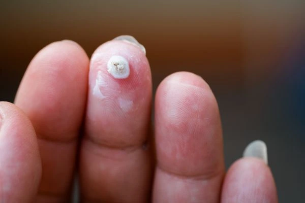 wart on person finger - cryotherapy to treat from LA LIPO Great Yarmouth