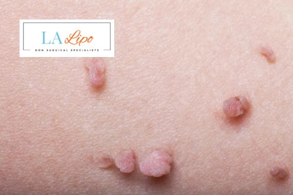 Does cryopen skin tag removal Great Yarmouth hurt? Find out now call our team today!