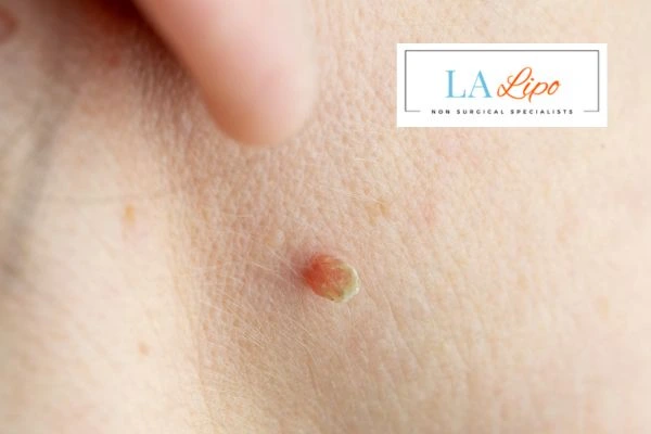 Book skin tag removal Great Yarmouth today speak to our team now!