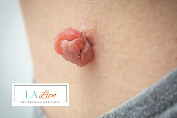 Interested in skin tag removal Great Yarmouth? Concerned about the pain? Find out more today!