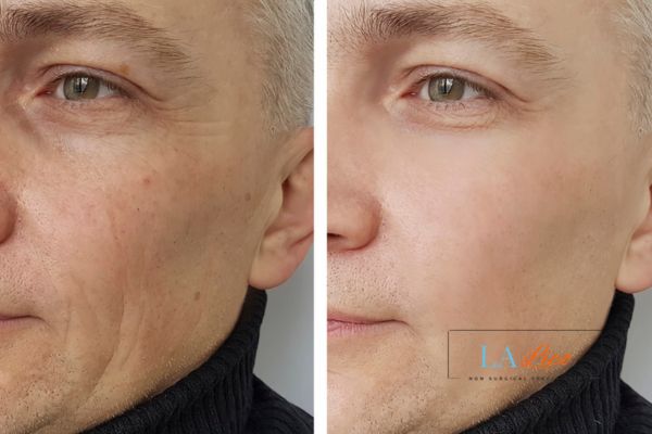See the amazing results of Morpheus8 Treatment Great Yarmouth!