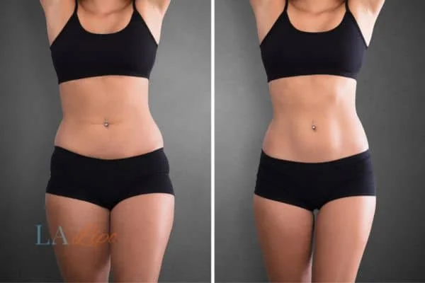 before and after results of non-surgical treatment to help a woman's body image and mental health Great Yarmouth