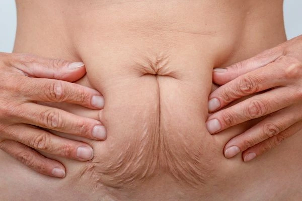 Image of a woman's stomach with loose skin - example of skin tightening Great Yarmouth options